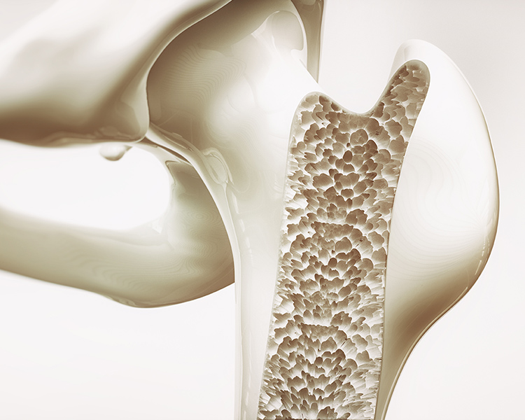 ビスフォスフォネート